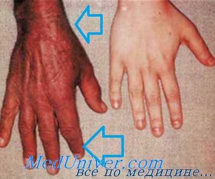 Гемохроматоз