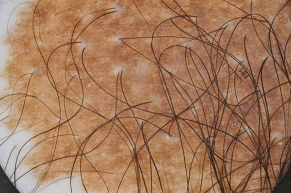 Волосы, растущие на невусе