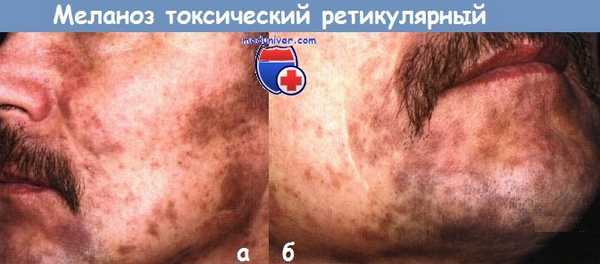 Меланоз токсический ретикулярный