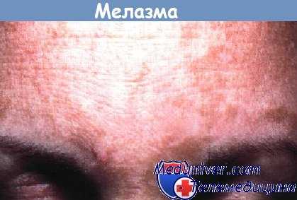 Мелазма