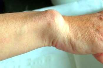 Довольно часто у молодых людей и подростков появляются тупые боли в конечностях. Усиливающиеся по ночам они могут свидетельствовать о появлении редкой доброкачественной аномалии развития скелета – мелореостоза (ризомономелореостоз). 