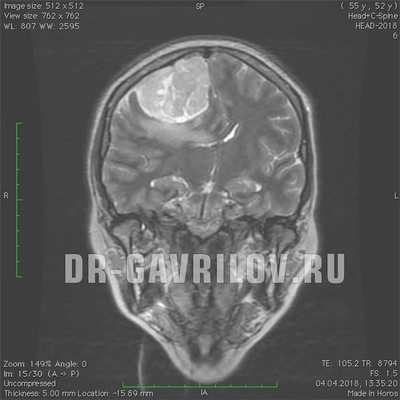 Менингиома головного мозга
