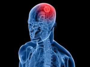 менингиома