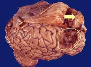 локация опухоли