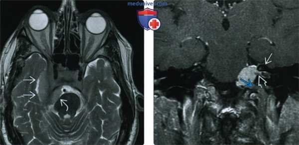 КТ, МРТ при менингиоме основания черепа