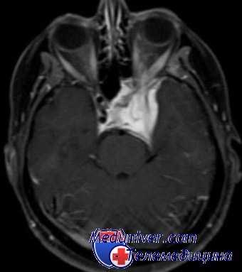 МРТ при менингиоме головного мозга