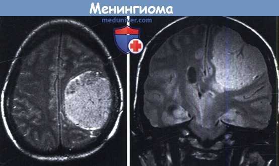 Менингиома