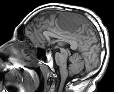 менингиома ВСС-саг
