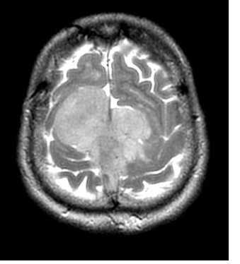менингиома ВСС-акс