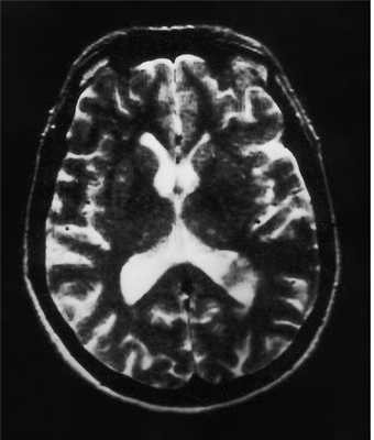 внутрижел-Т2