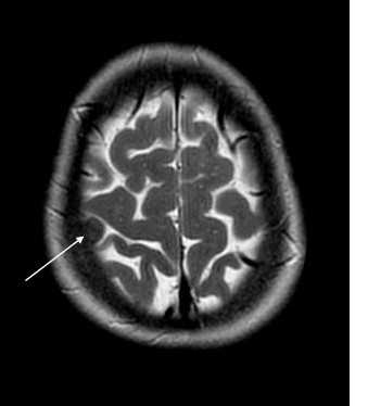 менингиома-Т2
