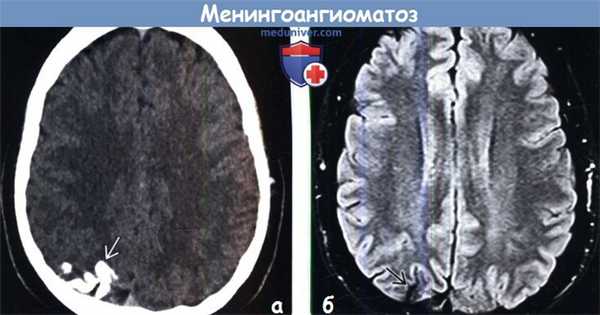 Менингоангиоматоз на КТ, МРТ