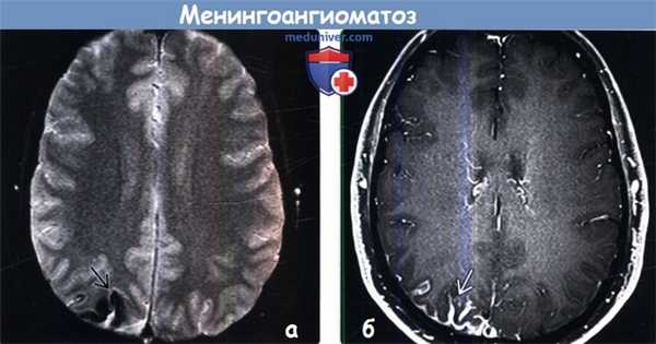 Менингоангиоматоз на МРТ