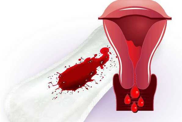 Обильное кровотечение во время месячных