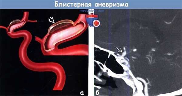 Блистерная аневризма головного мозга на КТ, ангиограмме