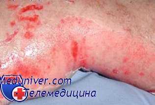 электротравма