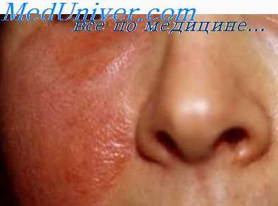 рецидивы рожи