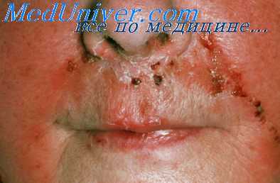 рецидивы рожи