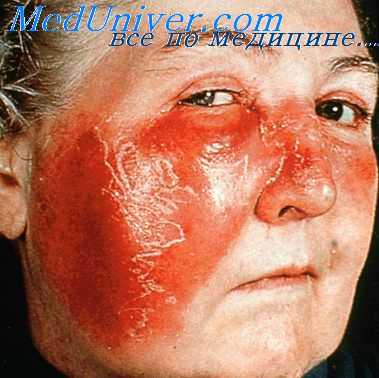 больные рожей