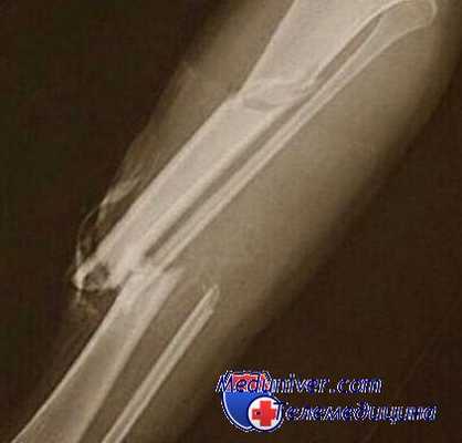 посттравматический сепсис