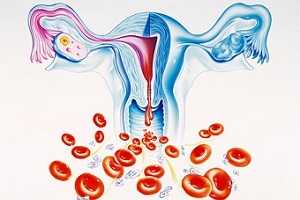 Обильные менструальные кровотечения