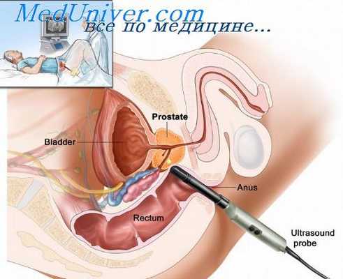 исследование простаты