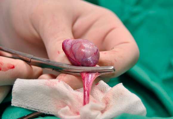 Удаление яичка у мужчины