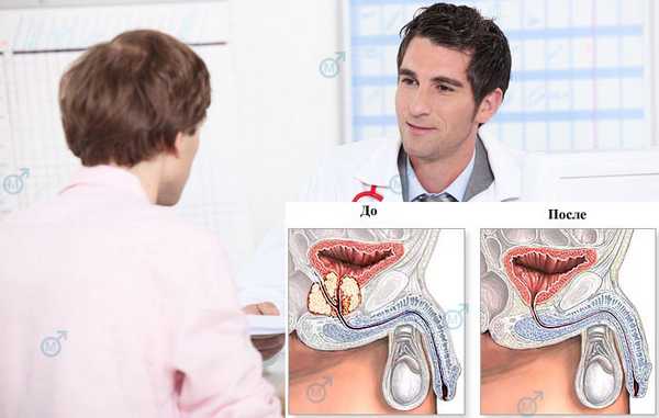 Опасность рака предстательной железы