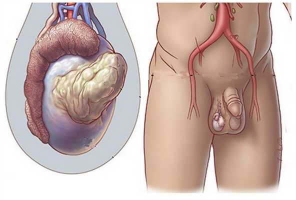 Как проводится орхиэктомия
