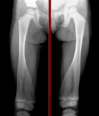 Болезнь Пайла