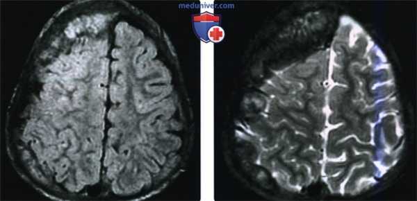 КТ, МРТ при метастатической нейробластоме головы и шеи