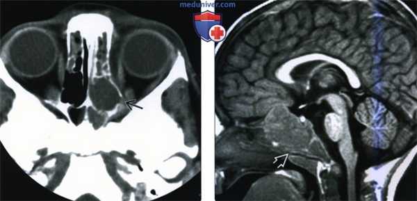 КТ, МРТ при метастатической нейробластоме головы и шеи