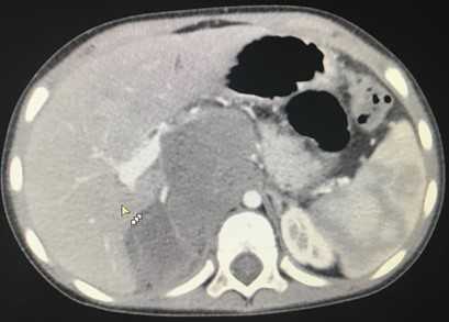 Рис. 5. КТ нейрогенного образования забрюшинного пространства справа