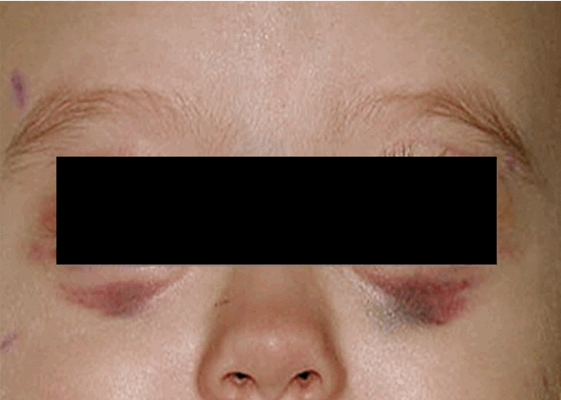 Рис. 3. Симптом «очков»