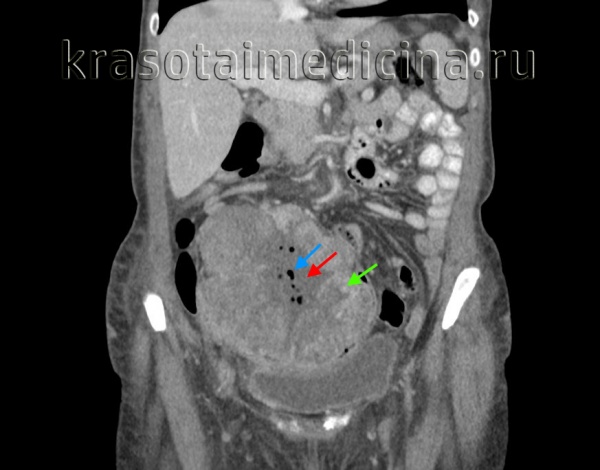 КТ живота и таза. Массивное объемное образование яичника с гиповаскулярным центром (красная стрелка), гиперваскулярной периферией (зеленая стрелка) и включениями газа (синяя стрелка). Гистологически подтвержденная гранулезоклеточная опухоль яичника.