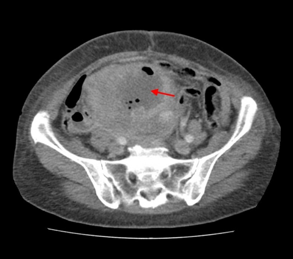 Гранулезоклеточная опухоль яичника