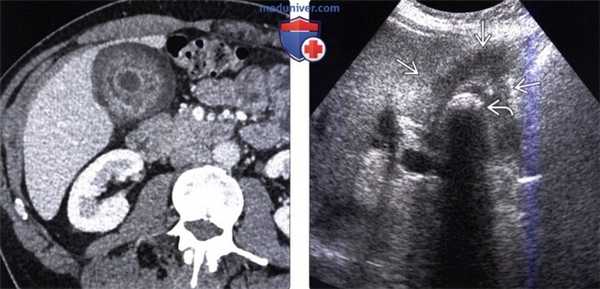 КТ, МРТ, УЗИ признаки рака желчного пузыря