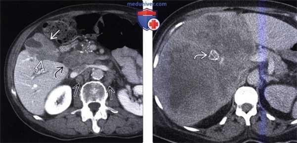 КТ, МРТ, УЗИ признаки рака желчного пузыря