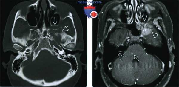 Метастазы в основании черепа - лучевая диагностика
