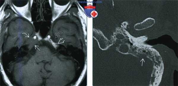 Метастатическое поражение височной кости - лучевая диагностика