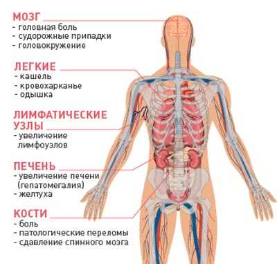 распространенные локализации метастазов рака
