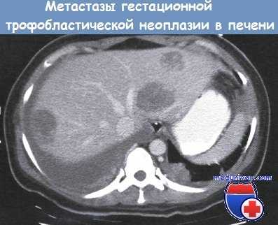 Метастазы гестационной трофобластической неоплазии в печени