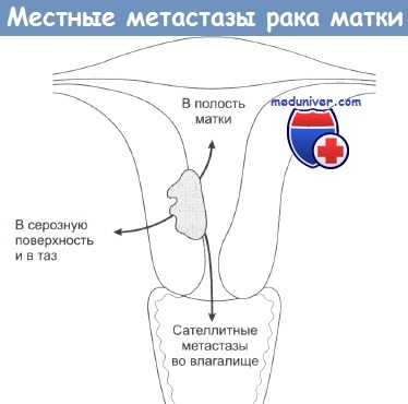 Местные метастазы рака матки