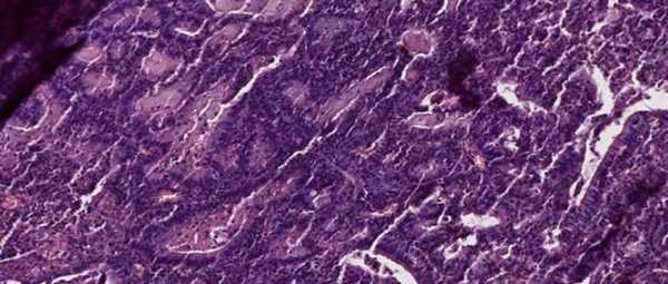 аденокарцинома эндометрия