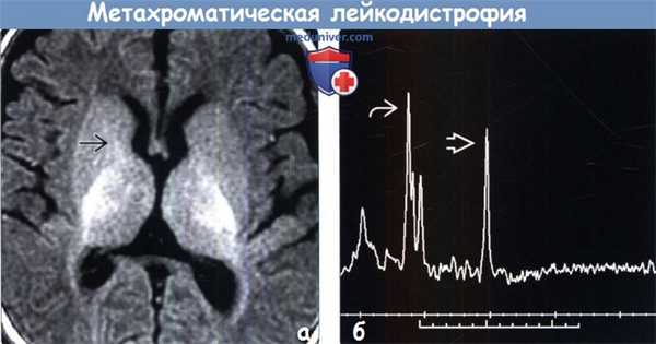 Метахроматическая лейкодистрофия на МРТ головного мозга