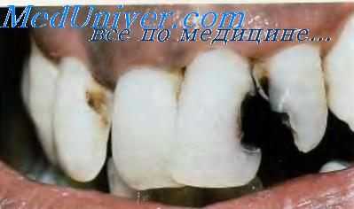 протезирование зубов