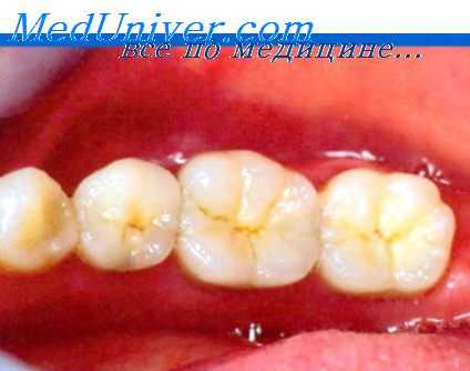 присасываемость полости рта