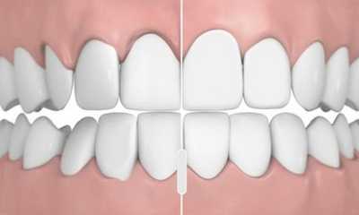 Прикус и его аномалии по Симону