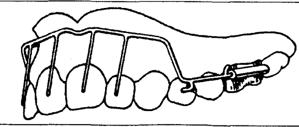 Показания к установке аппарата Симона
