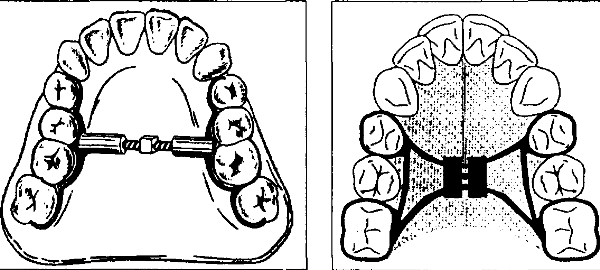 Аппарат Симона цена
